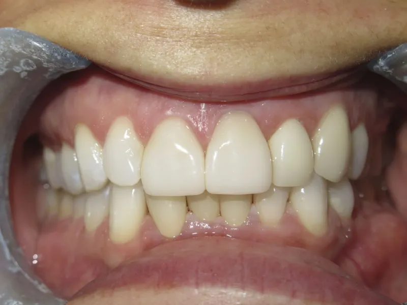 picture of case 604 retracted after