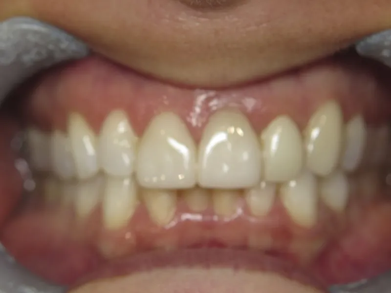 picture of case 604 retracted before