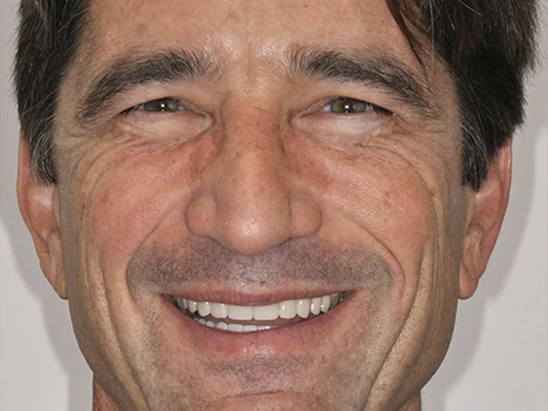 giving a patients smile a more youthful look picture