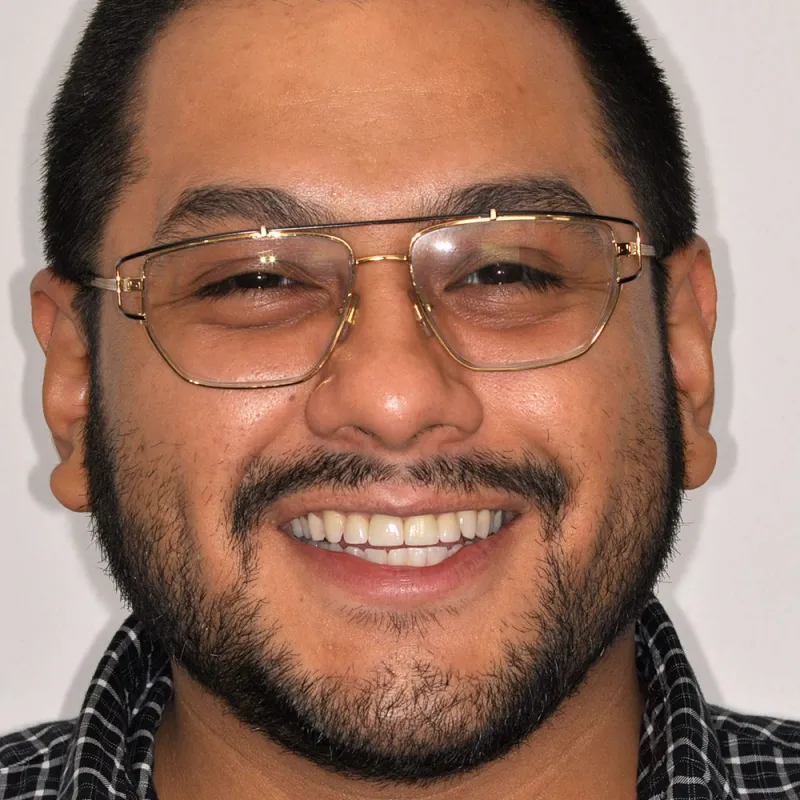After using crowns, implants, and veneers to repair a smile