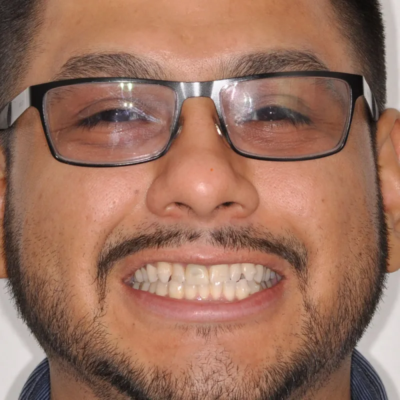 Before using crowns, implants, and veneers to repair a smile