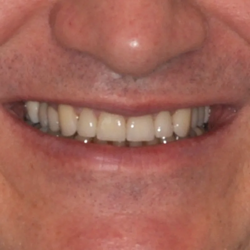 After Using Implants to Repair a Smile