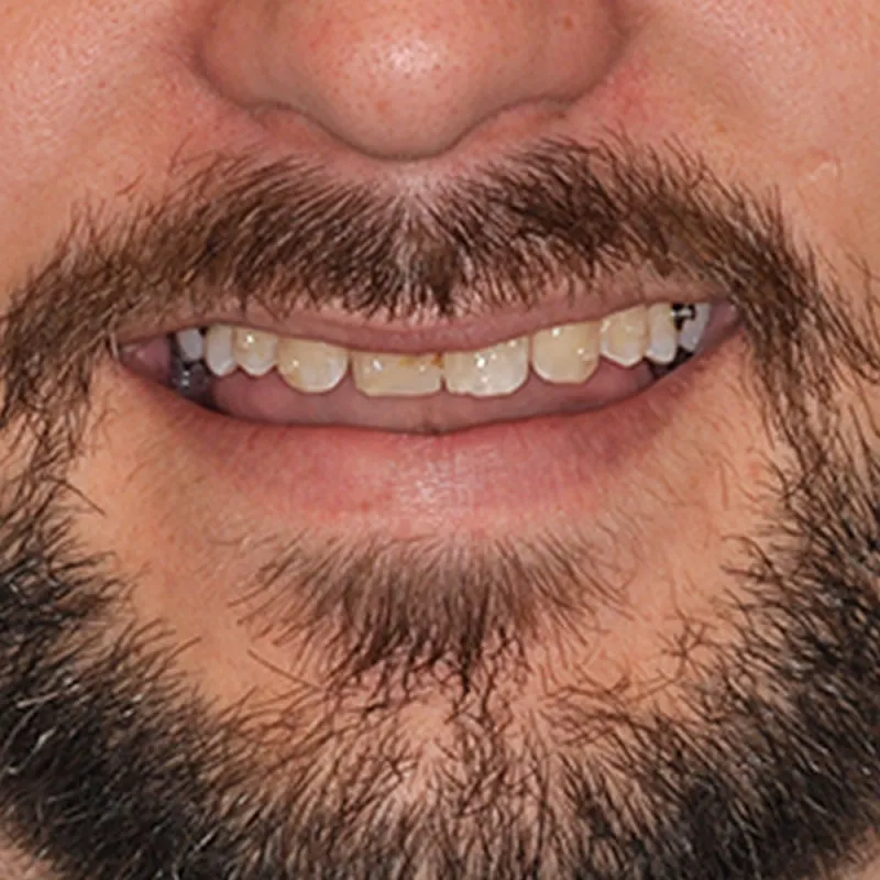 Before Fixing Missing and Misaligned Teeth