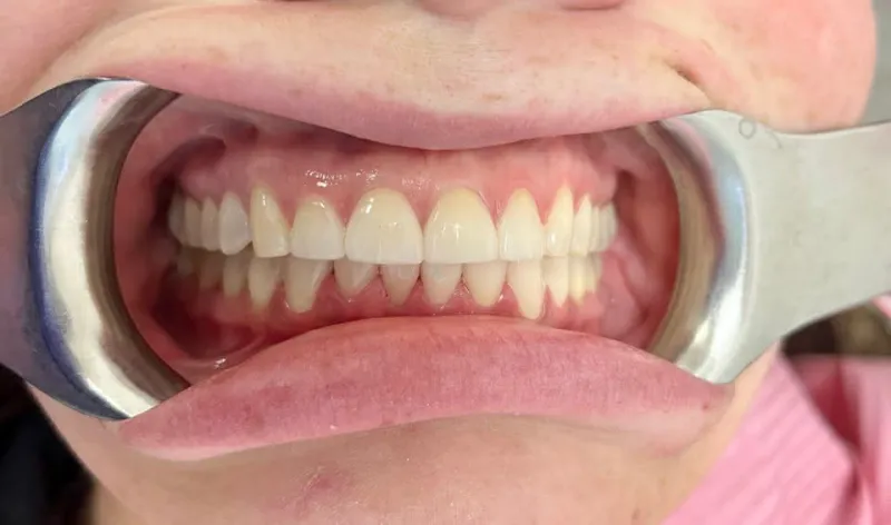 A closeup of a retracted smile