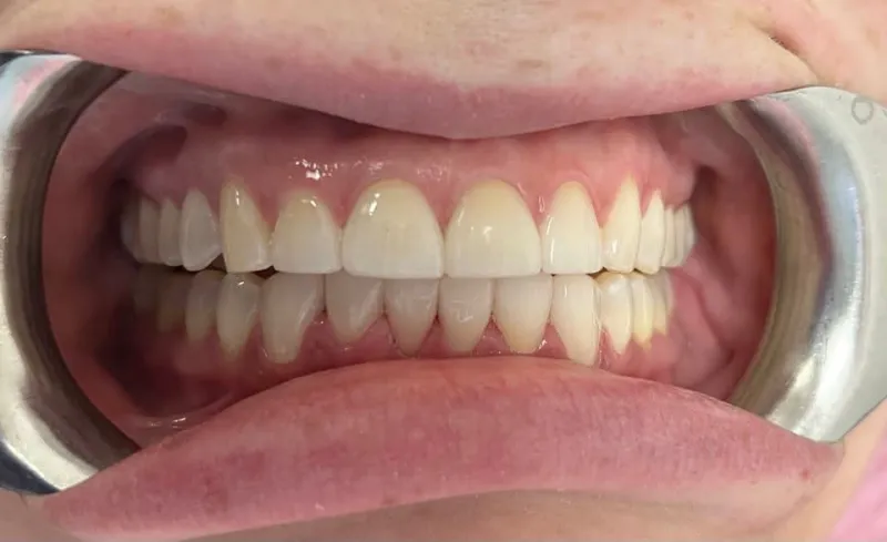 A retracted smile closeup