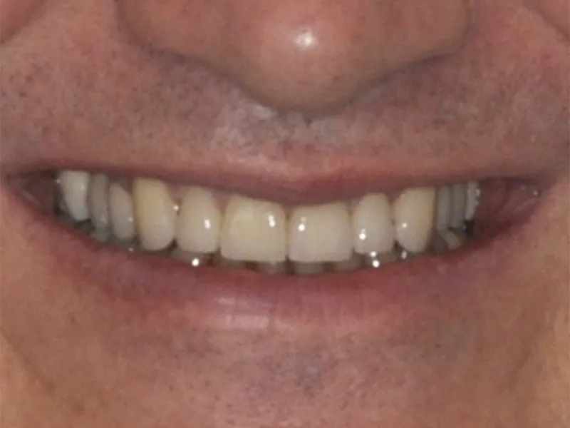 using implants to repair a smile photo